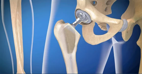 Substituição do Quadril